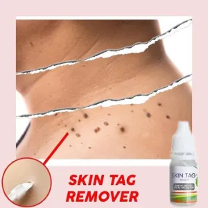 Skin Tag Remover