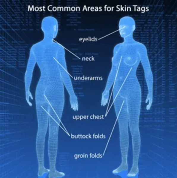 Skin Tag Remover
