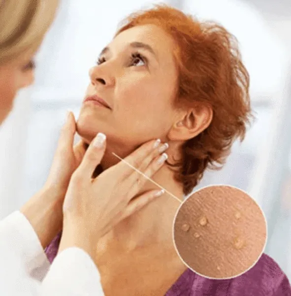 Skin Tag Remover
